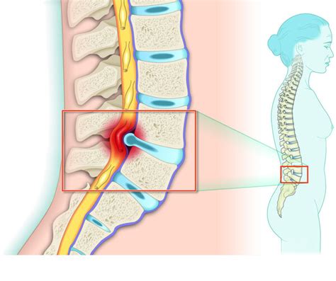 Bandscheibenvorfall Diagnose Apotheken Umschau