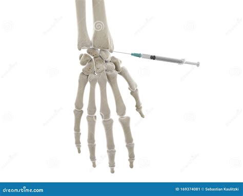 A Wrist Injection Stock Illustration Illustration Of Anatomy 169374081