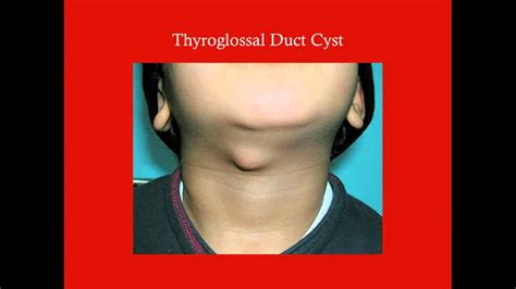 Thyroid Crash Medical Review Series Youtube