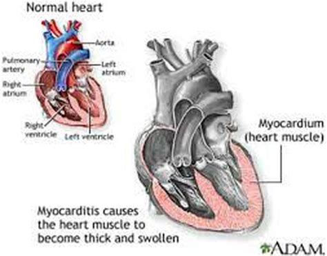 Myocarditis Medizzy