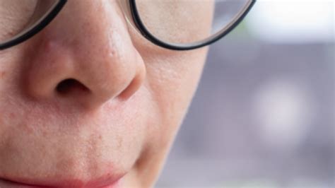 Herpes labial Por qué aparecen fuegos en los labios