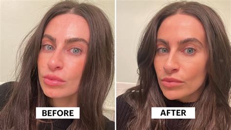 I Used Filler to Get Rid of My Cleft Chin | Allure