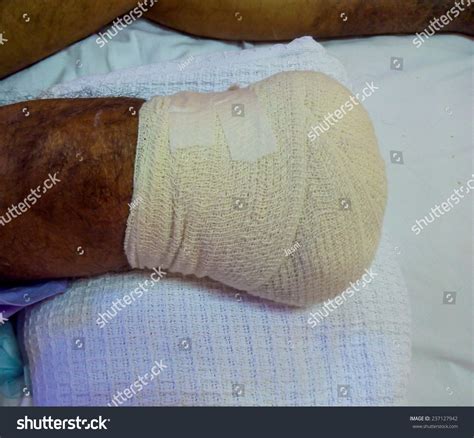 Below Knee Amputation Stump. Stock Photo 237127942 : Shutterstock