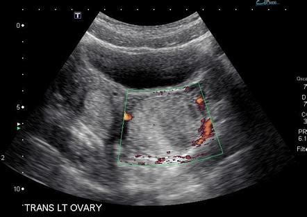 Hemorrhagic Ovarian Cyst Radiology Reference Article Radiopaedia Org