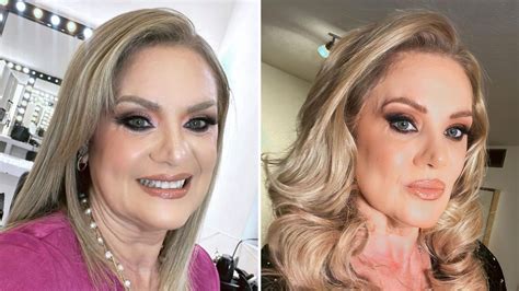 Erika Buenfil Se Hace Procedimiento Estético En El Rostro Y Muestra