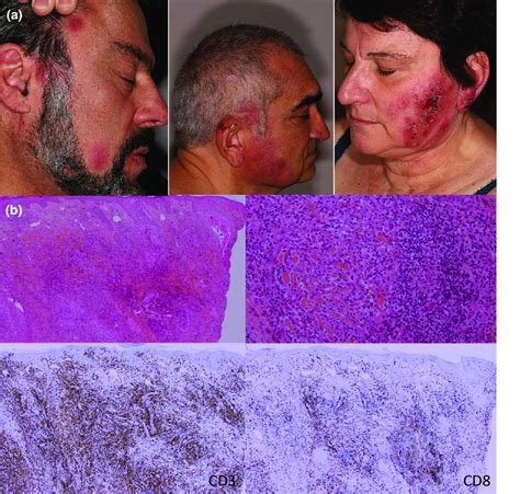 Clinical And Histological Characteristics Of Granulomatous Photoexposed