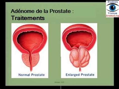 Traitements de Adénome de la prostate YouTube