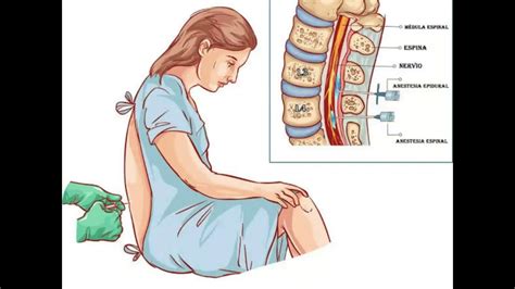 Tipos de Anestesia y Actividades de Enfermería YouTube