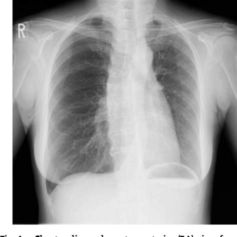 Figure From Isolated Unilateral Proximal Interruption Of The