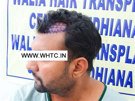 What is hairline reconstruction ? - Walia Hair Transplant