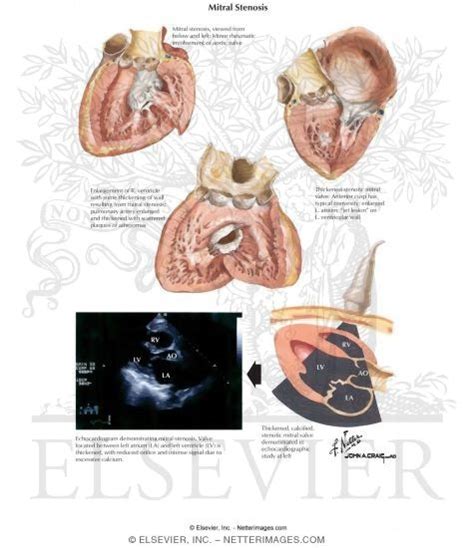 Pathophysiology Of Mitral Stenosis