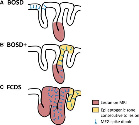 Remote Meg Dipoles In Focal Cortical Dysplasia At Bottom Of Sulcus