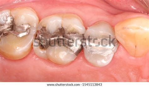 Dental Amalgam Dental Restoration Defective Filling 스톡 사진지금 편집 1545113843