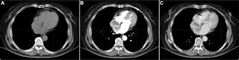 Frontiers Multimodality Imaging Evaluation Of Primary Right Atrial