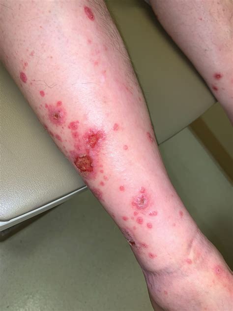 Diffuse Papular Eruption With Erosions And Ulcerations Mdedge Dermatology