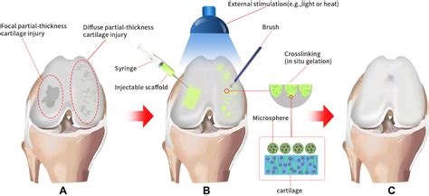 Schematic Diagram Of The Bottom Up Cartilage Repair Process A