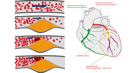 Herzinfarkt Ursachen Und Risikofaktoren Herzbewusst De