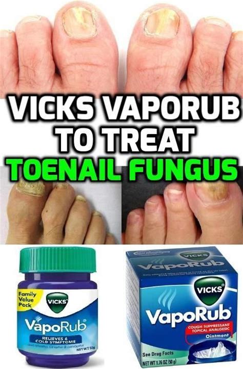 Vicks Vaporub Contains Antimicrobial Anti Inflammatory And Analgesic