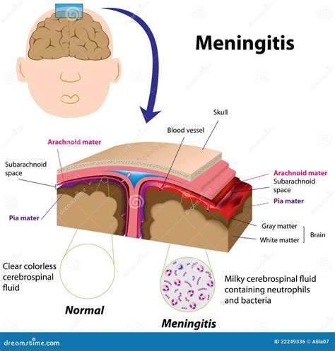 Meningitis Stock Vector Illustration Of Condition Human 22249336