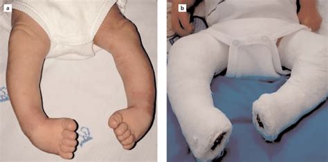 In pes equinovarus deformity (a), the image of long leg casting (b ...