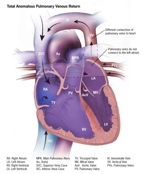 Trial Shows Adding Chemotherapy Helps Kids Live With Pulmonary Vein Stenosis | CheckRare