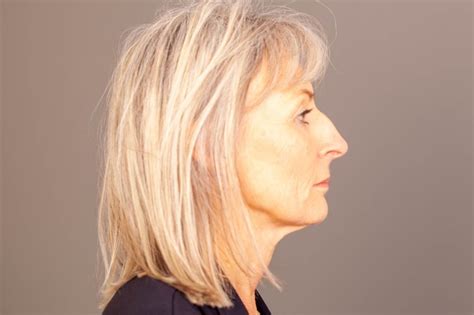 Rhinoplasty Gold Coast Specialist Plastic Surgeon Dr Mark Doyle