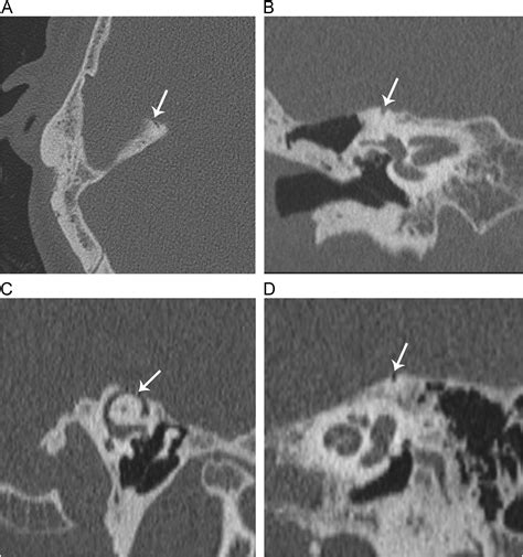 Semicircular Canal Dehiscence Operative Techniques In Otolaryngology Head And Neck Surgery