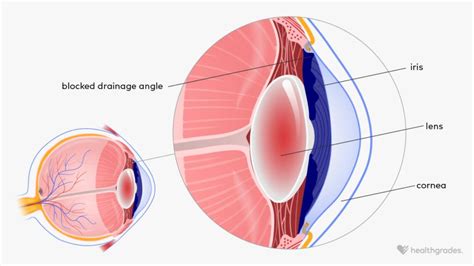 Narrow Angle Glaucoma Symptoms Causes And Treatment