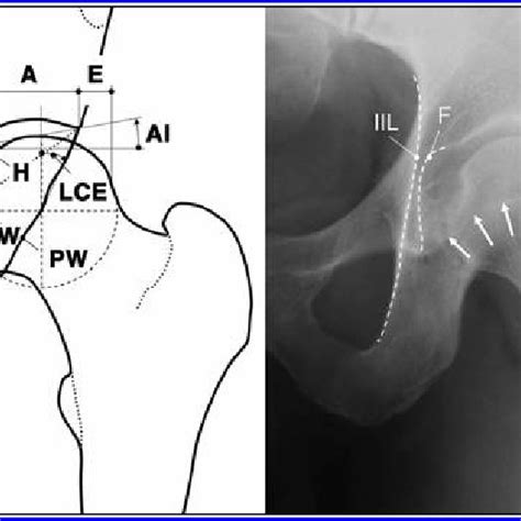 Schematic Left And Radiographic Right Appearances Of Normal Hip Download Scientific Diagram