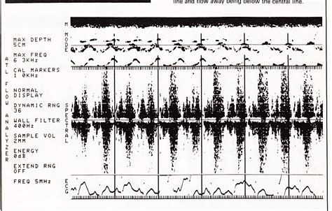 Figure From Pulsed Doppler Echocardiography In The Diagnosis Of