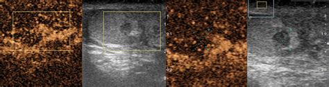 Evidences At Contrast Enhanced Ultrasound Of The Scrotum A Rapid