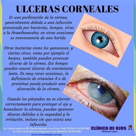 Cl Nica De Ojos Oftalmic L Ser Ulceras Corneales Enfermedades Del