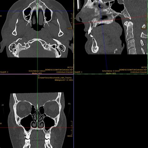 Example Planes For The Definition Of The Median Plane In Ct Scan