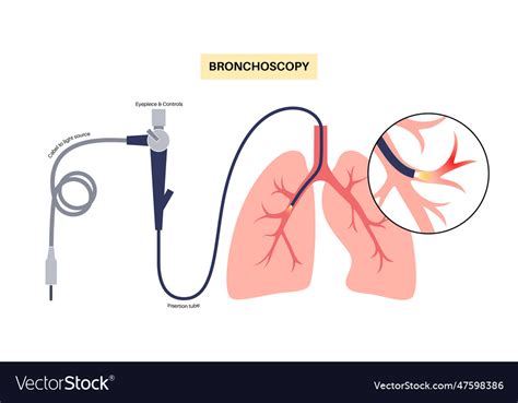 Bronchoscopy procedure concept Royalty Free Vector Image