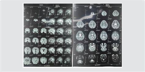 Figure From A De Novo Scn A Mutation Identified In A Chinese Patient