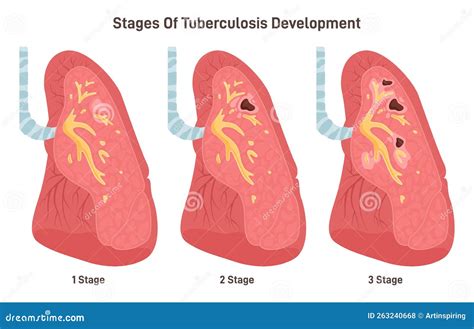 Fasi Di Sviluppo Della Tubercolosi Malattia Del Sistema Respiratorio