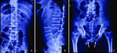 Preoperative Anteroposterior A And Lateral B Radiograph Show Download Scientific Diagram