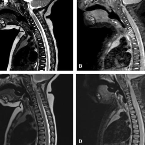 MRI Spine Sagittal View T2 Sequence A And Corresponding Sagittal View