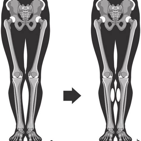 A 27-year-old female patient with varus deformity of the lower ...