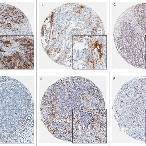 PDL1 PDL2 PD1 CD3 And CD8 Expression In Gastric Carcinoma By