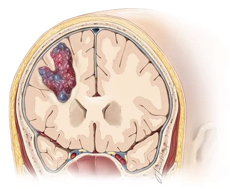 Evaluation of Cavernous Malformations | The Neurosurgical Atlas