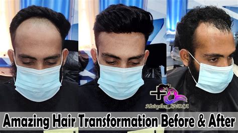 Customize Hair Patch Patna Customize Hair Patch For Men Best