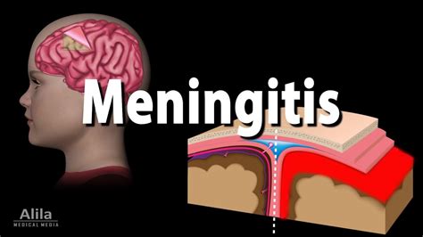 Bacterial Meningitis Diagram