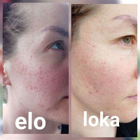 Miten Ruusufinni Eli Rosacea Voidaan Hoitaa Ekoel M Ni