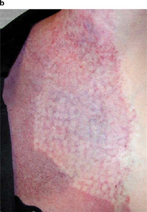 Port Wine Stain Pws Of Patient 2 Before A And After Two Download Scientific Diagram