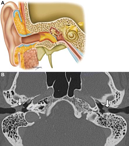 Imaging The External Ear Practical Approach To Normal And Pathologic Conditions Radiographics