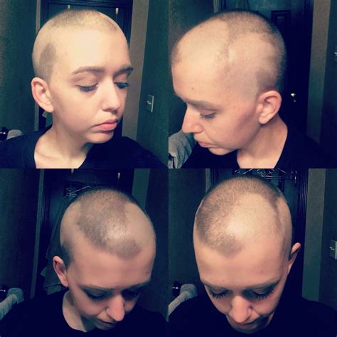 7 People Describe What It S Really Like To Have Alopecia Artofit