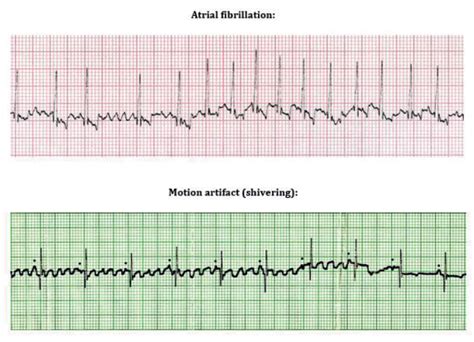 Atrial Fibrillation Vs Atrial Flutter