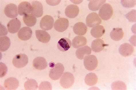 Plasmodium Malariae Blood Smear Hot Sex Picture