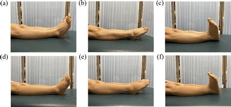 23 Plantar Flexion Contracture Troywessal